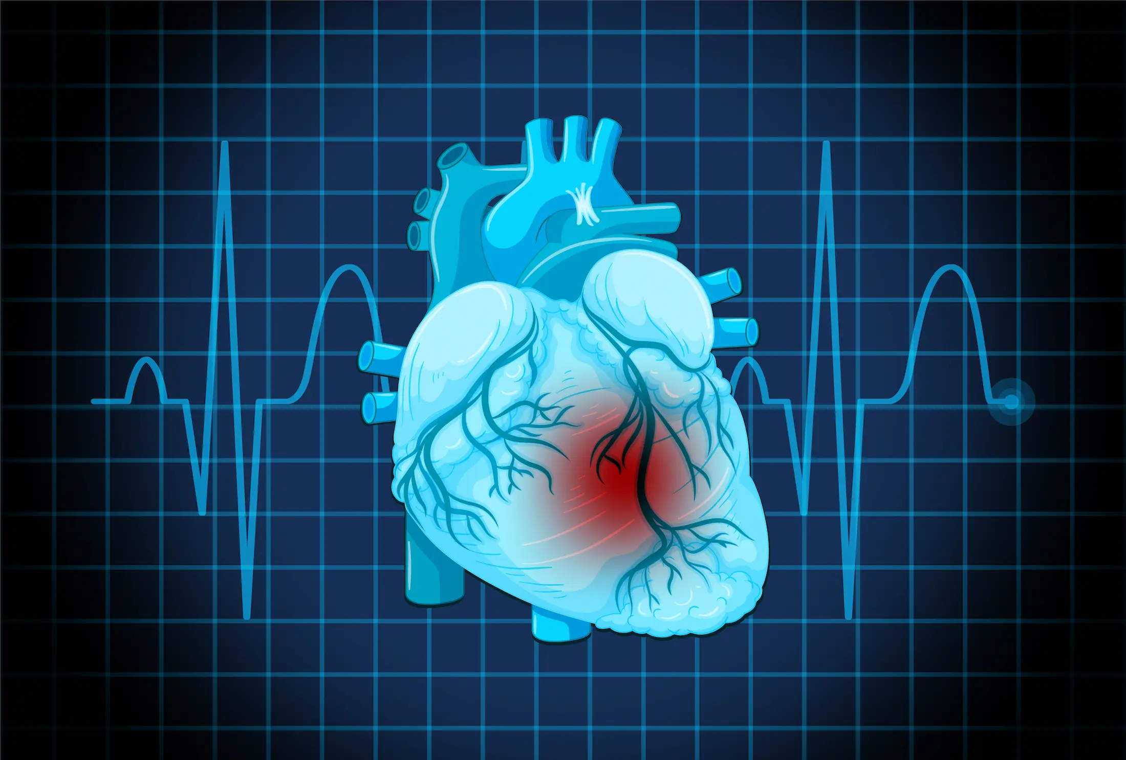 What are 4 Stages of Congestive Heart Failure (CHF)