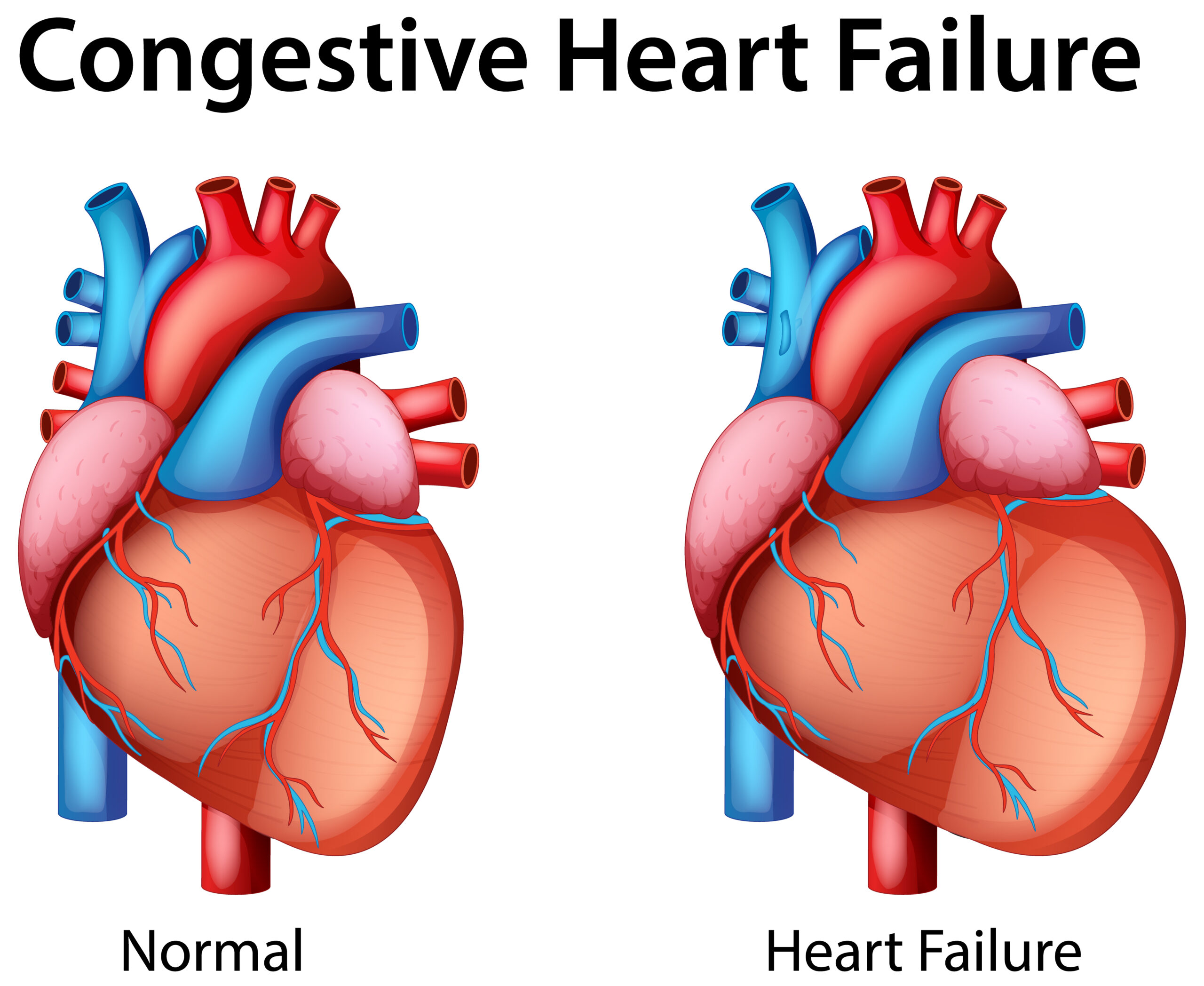 What are 4 stages of congestive heart failure