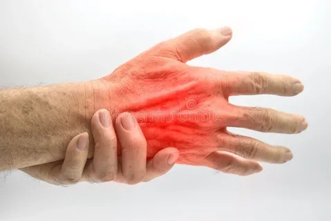rheumatoid arthritis symmetrical hand swelling